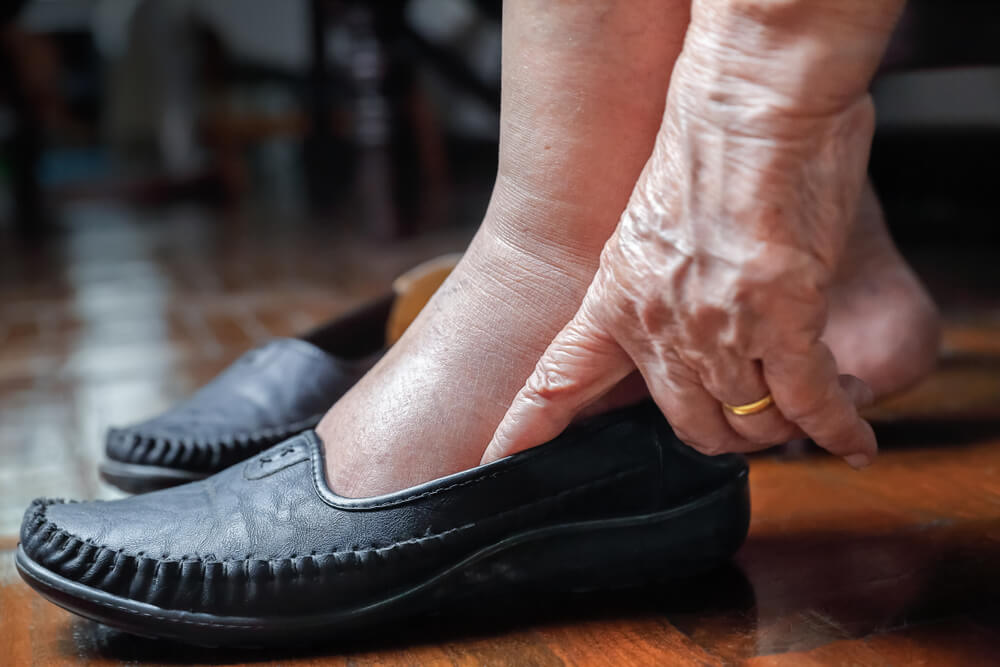 lymphedema therapy