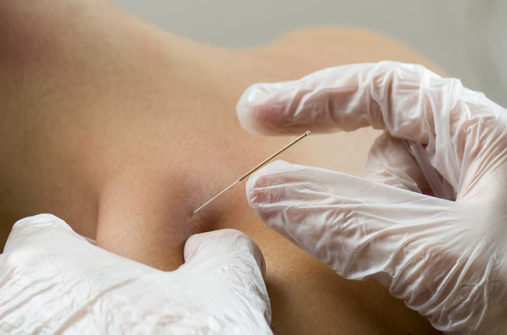 Visit a physical therapist in Grand Rapids, MI, for dry needling shutterstock 500321278 dry needling near you