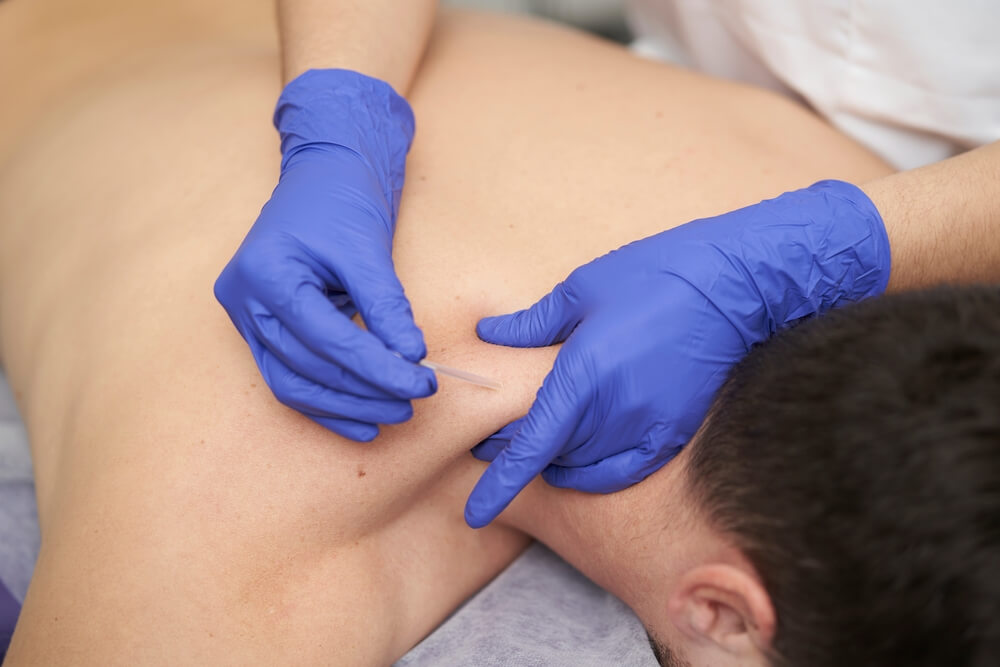 What are some benefits of trying dry needling near me? shutterstock 2141181079 dry needling near me