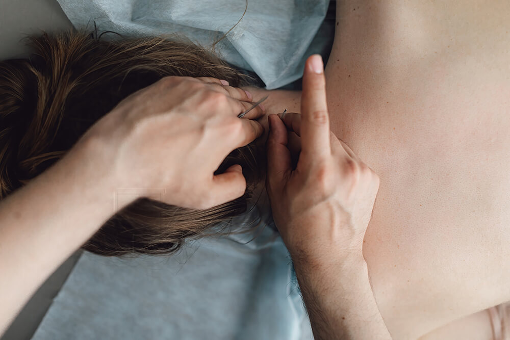 The pros and cons of dry needling woman stabbed in the back with needle in bright ac 2022 10 07 22 18 31 utc the pros and cons of dry needling dry needling