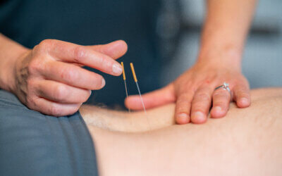 Dry Needling in Apache Junction, AZ